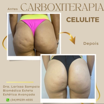 Carboxiterapia